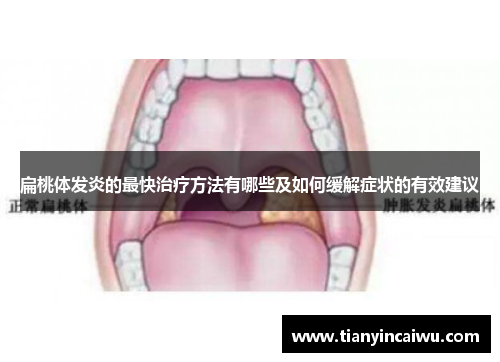 扁桃体发炎的最快治疗方法有哪些及如何缓解症状的有效建议